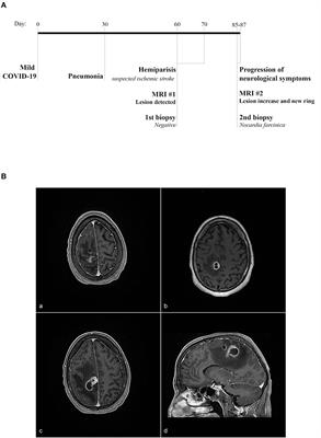 Encephalic nocardiosis after mild COVID-19: A case report